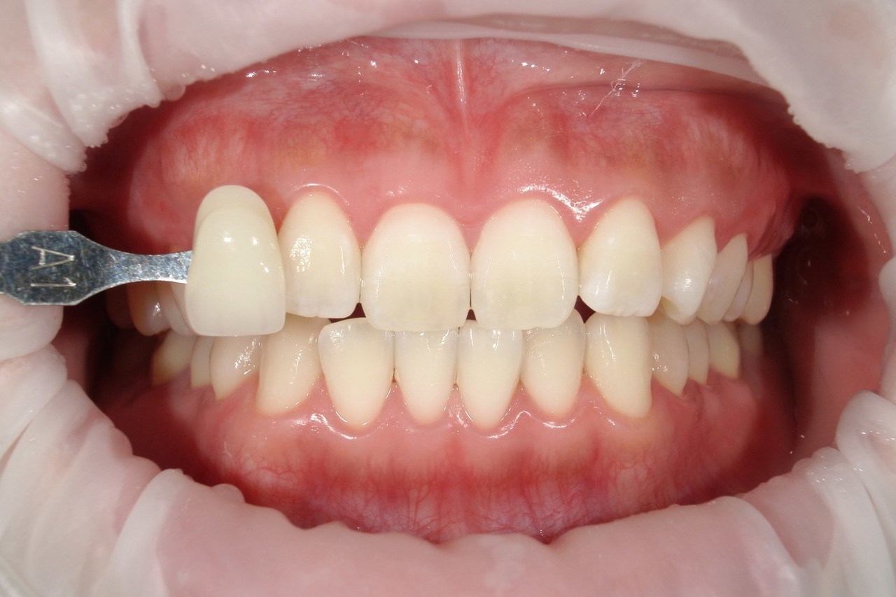 浜松市・浜名区・美園中央公園駅のホワイトニングの症例