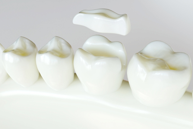 浜松市・浜名区・美園中央公園駅の歯ぎしり治療（ナイトガード）