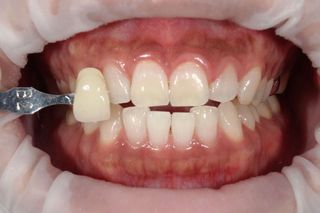 浜松市・浜名区・美園中央公園駅のホワイトニングの症例