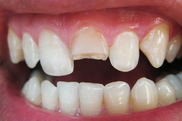 浜松市・浜名区・美園中央公園駅の歯ぎしり治療（ナイトガード）