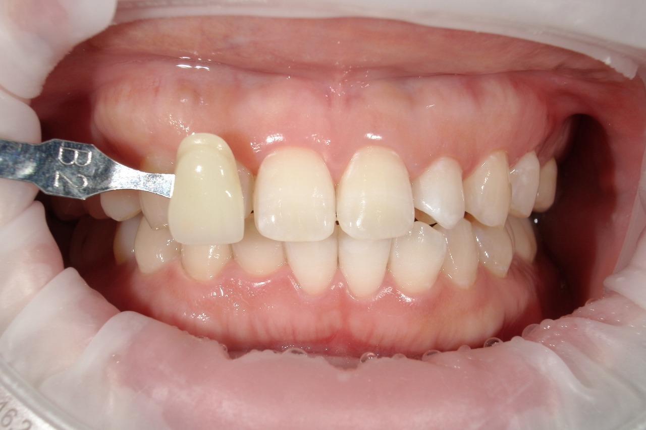 浜松市・浜名区・美園中央公園駅のホワイトニングの症例