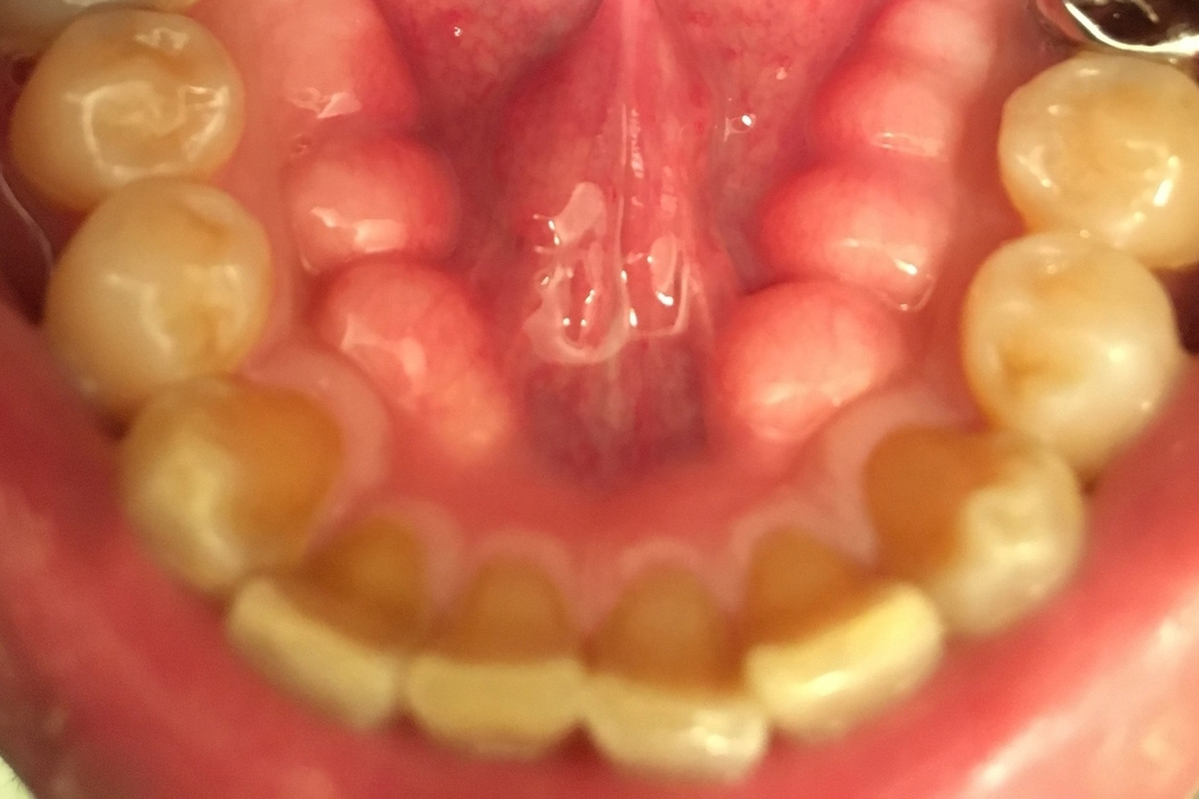 浜松市・浜名区・美園中央公園駅の歯ぎしり治療（ナイトガード）