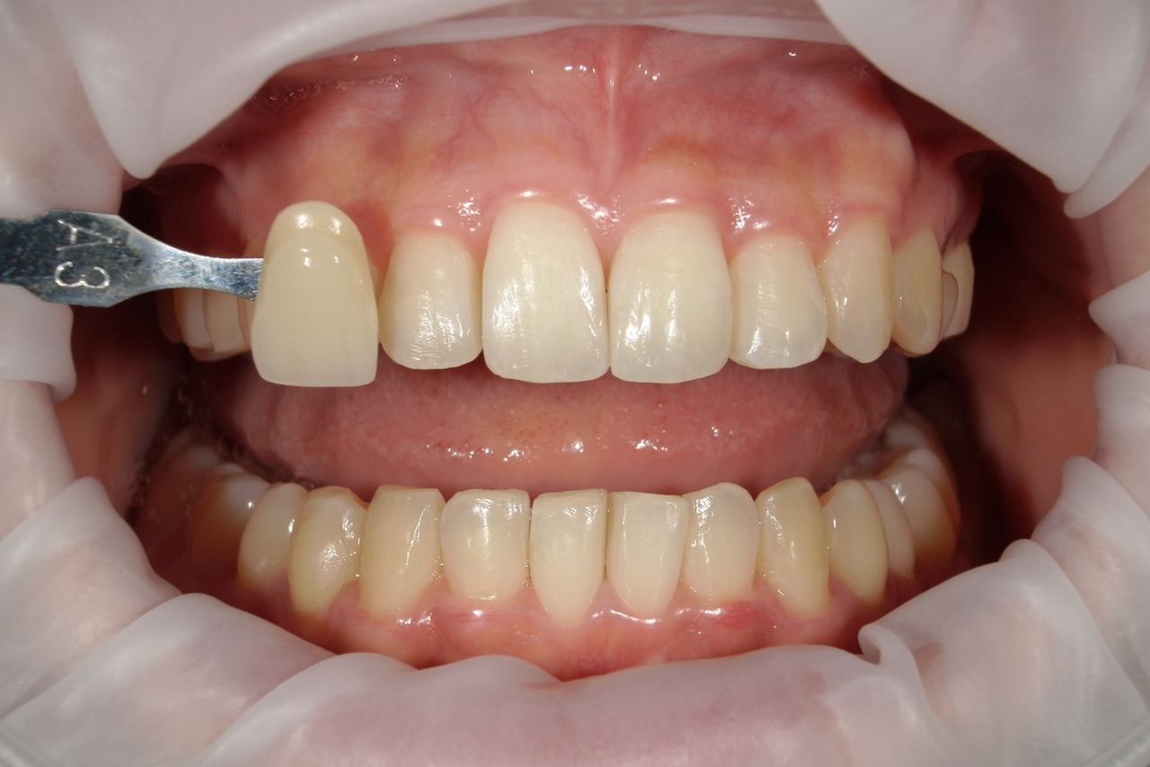 浜松市・浜名区・美園中央公園駅のホワイトニングの症例