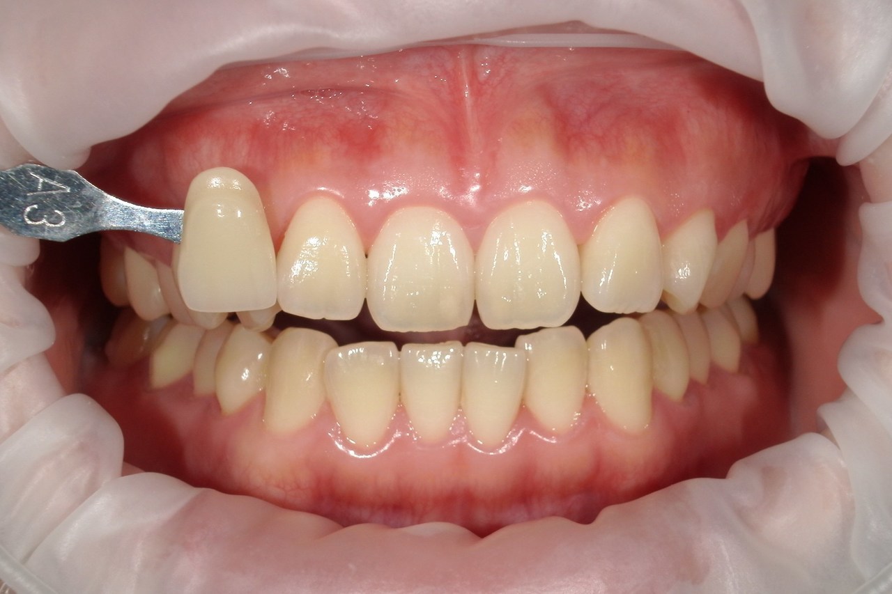 浜松市・浜名区・美園中央公園駅のホワイトニングの症例