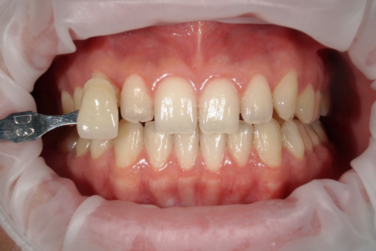 浜松市・浜名区・美園中央公園駅のホワイトニングの症例