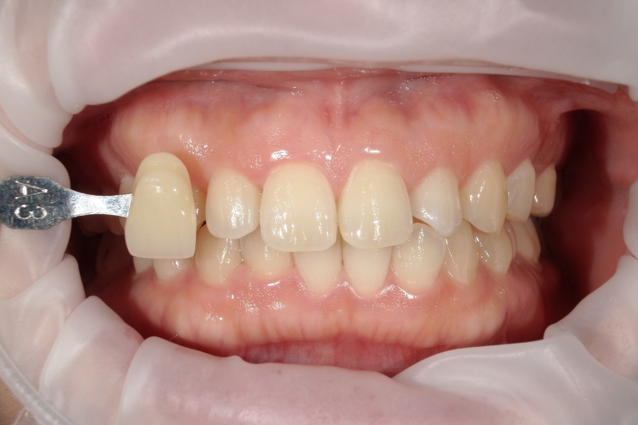 浜松市・浜名区・美園中央公園駅のホワイトニングの症例