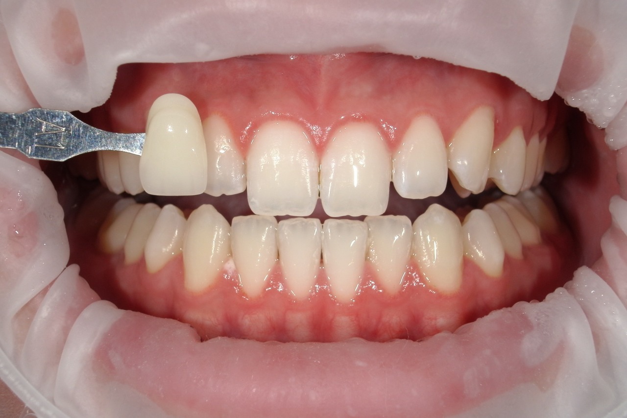 浜松市・浜名区・美園中央公園駅のホワイトニングの症例