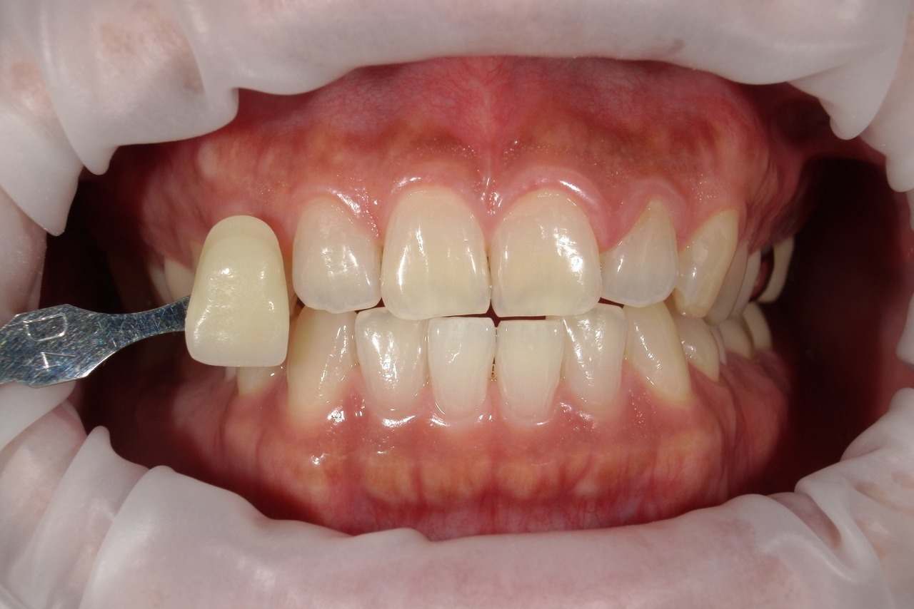 浜松市・浜名区・美園中央公園駅のホワイトニングの症例