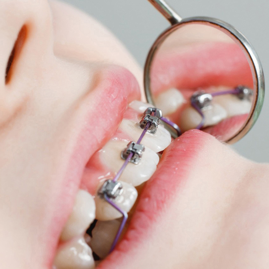 部分矯正治療 - きぶね歯科医院（貴布祢・美薗中央公園駅）